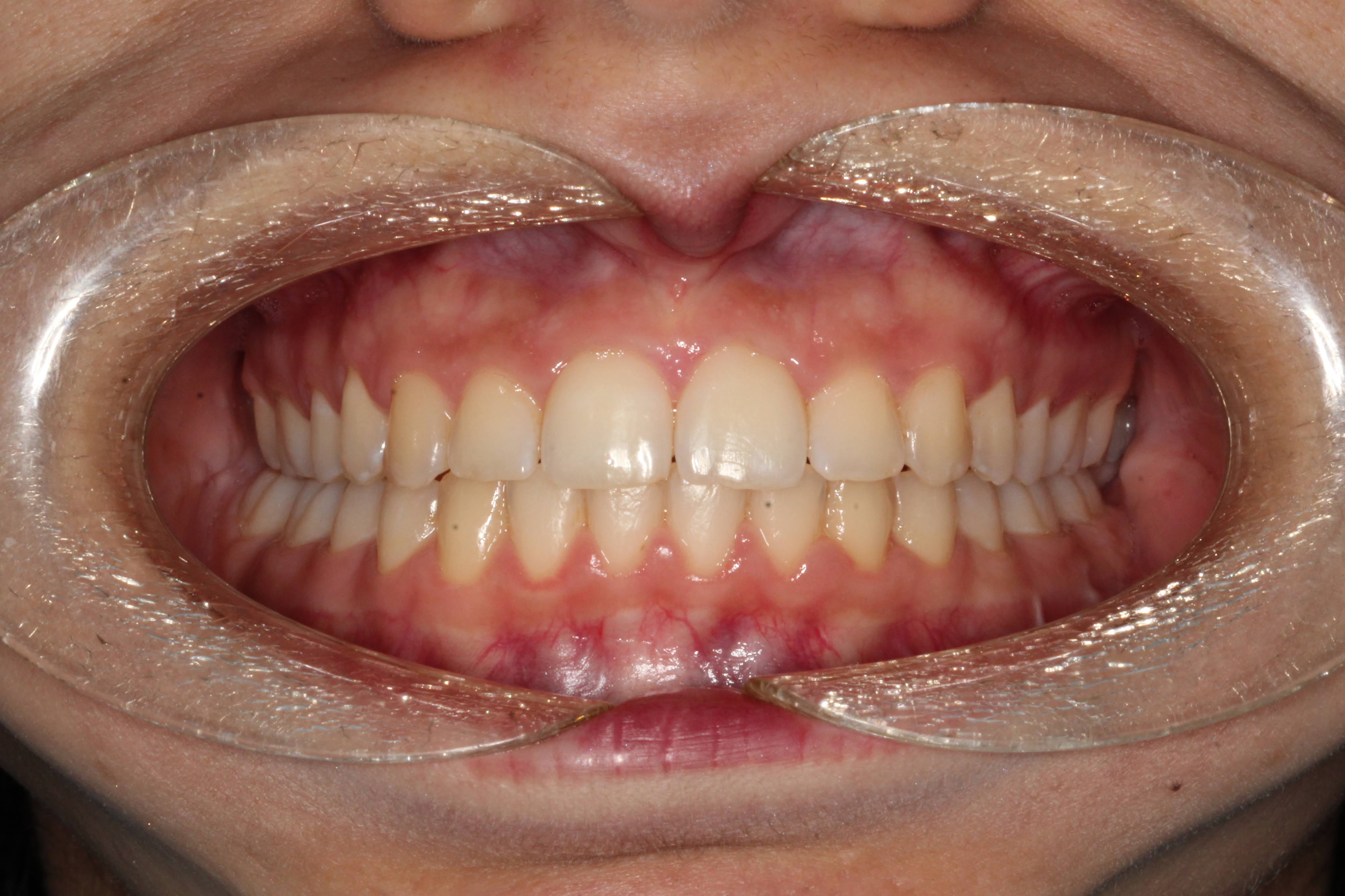 Fixed brace and lower jaw advancement surgery