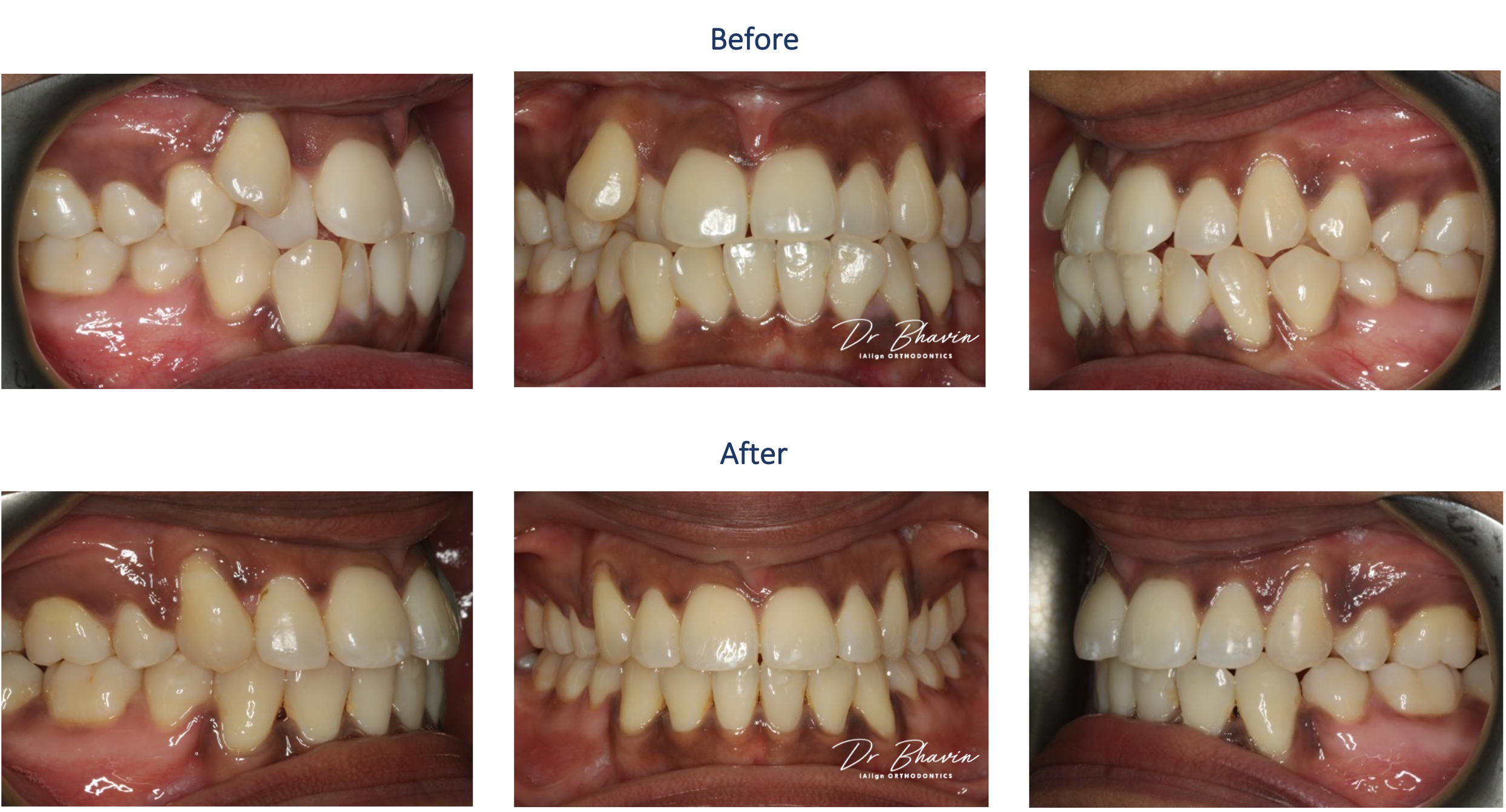Smile Transformation