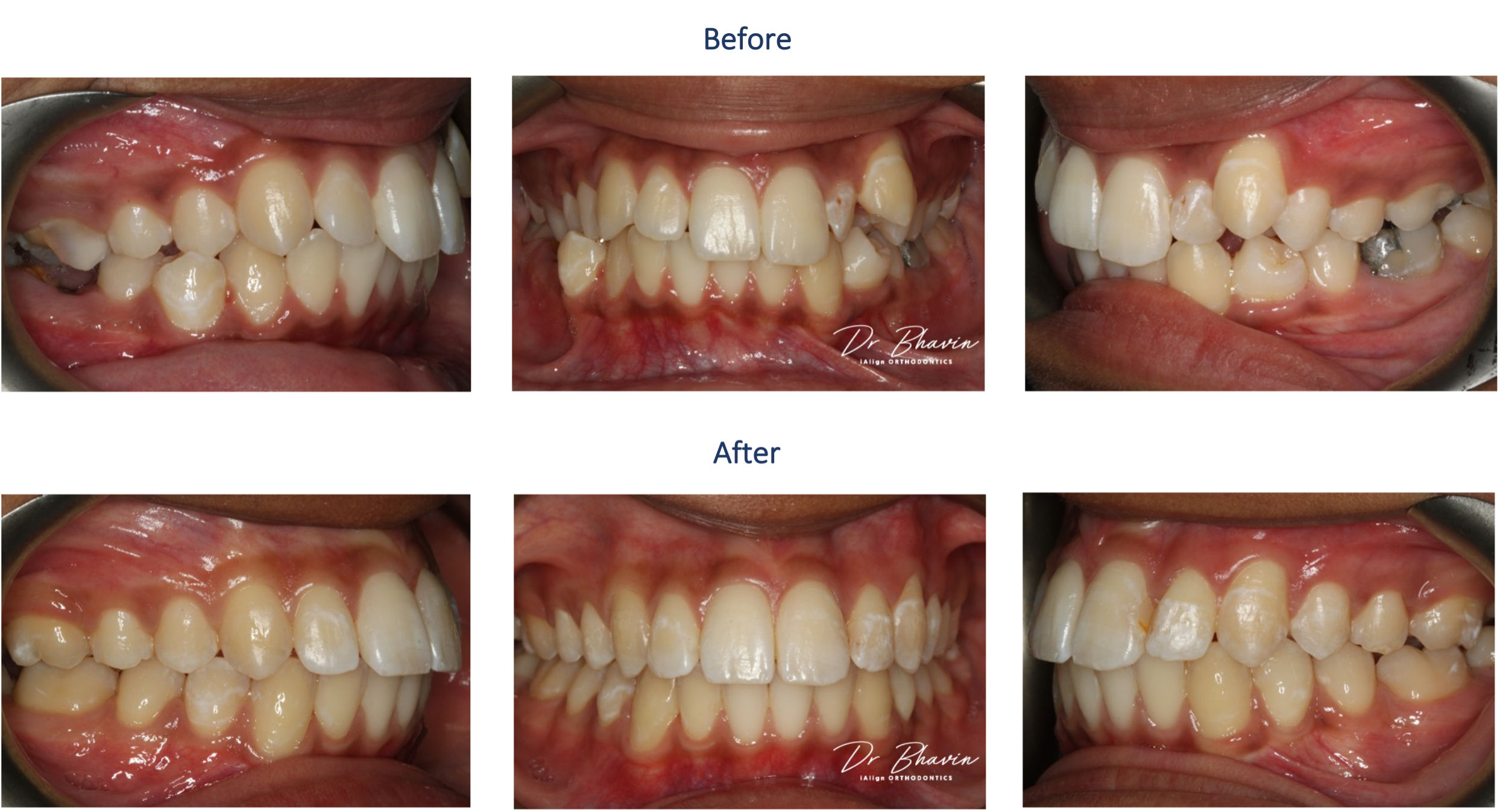 Smile Transformation