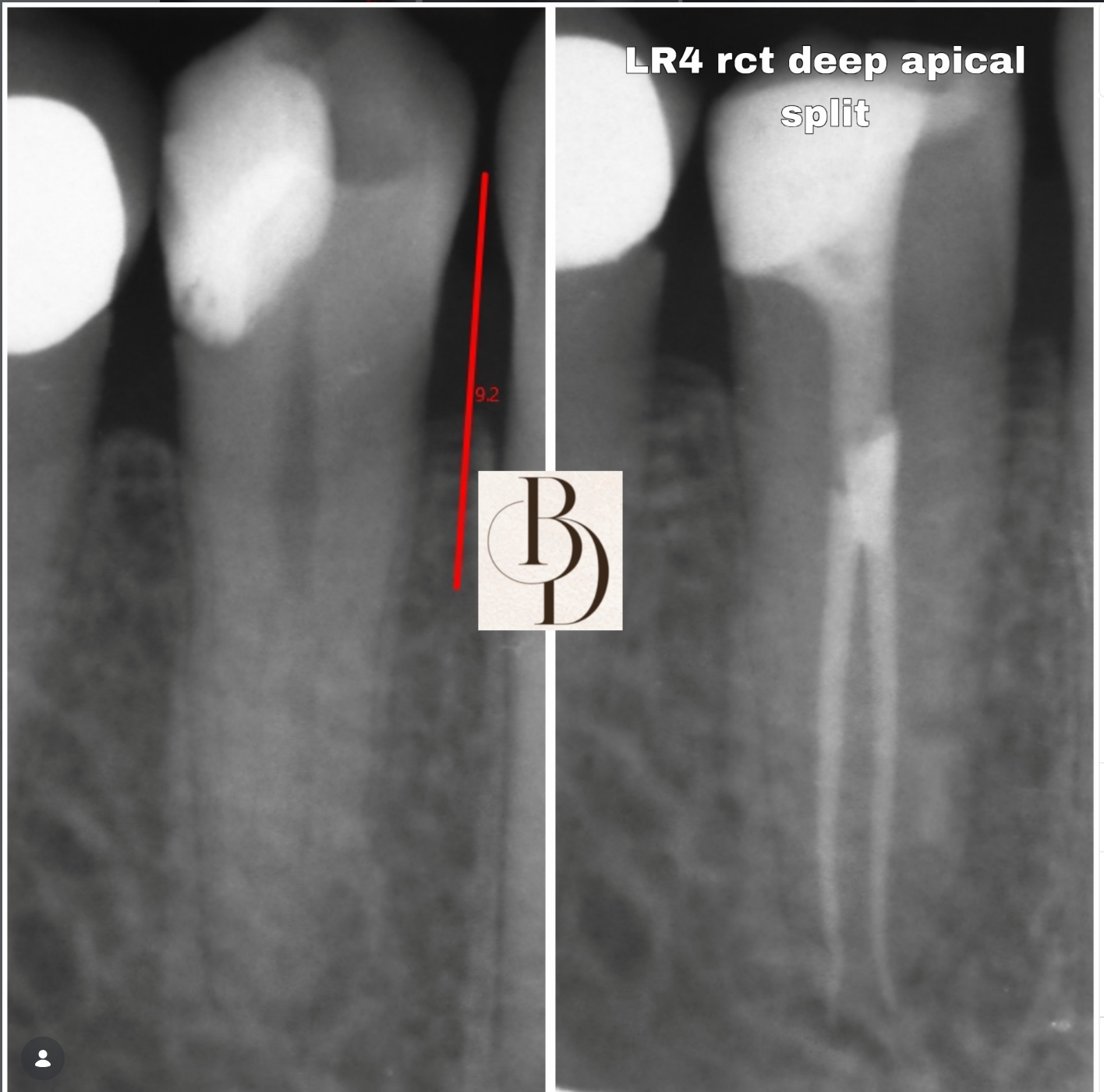 root canal lower premolar