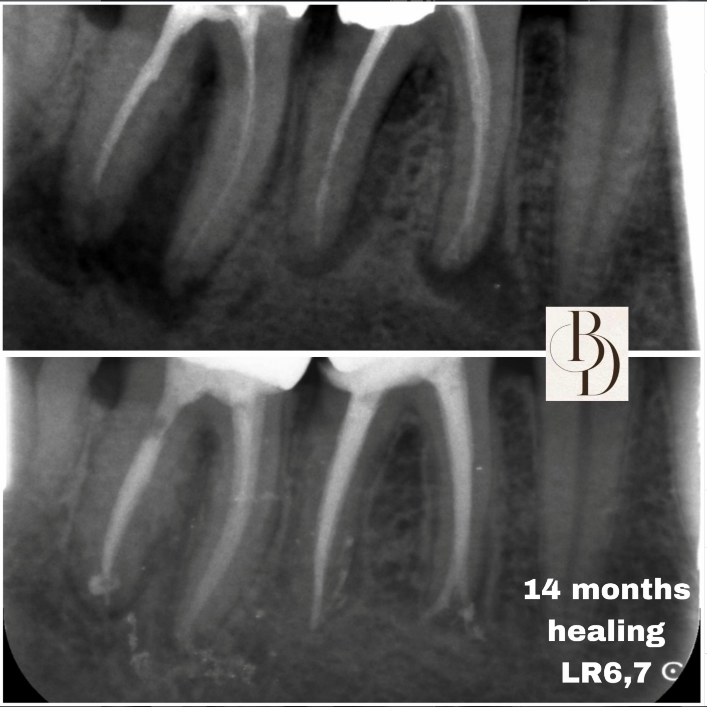 re rct large lesion healed after 1 year