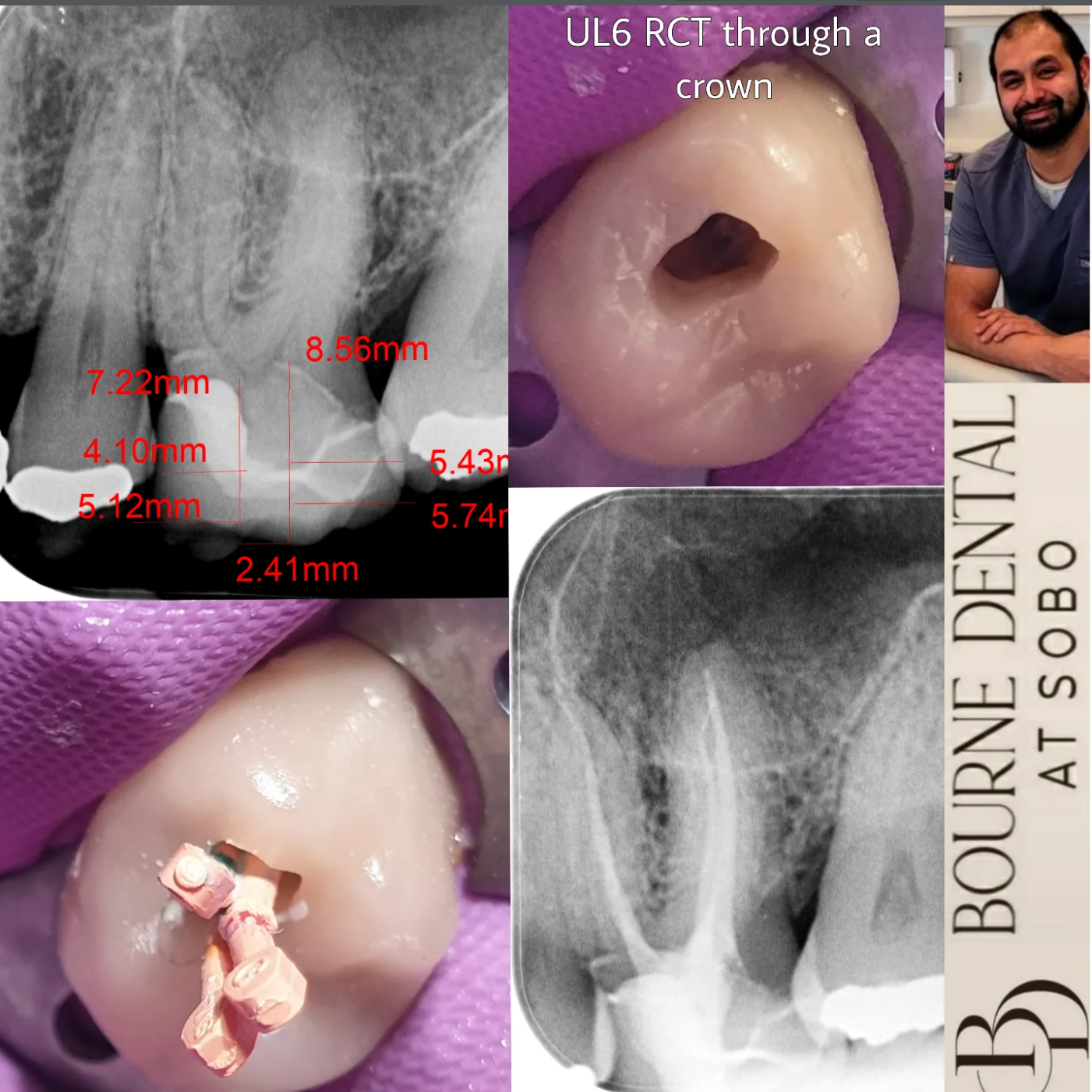 rct through recent crown