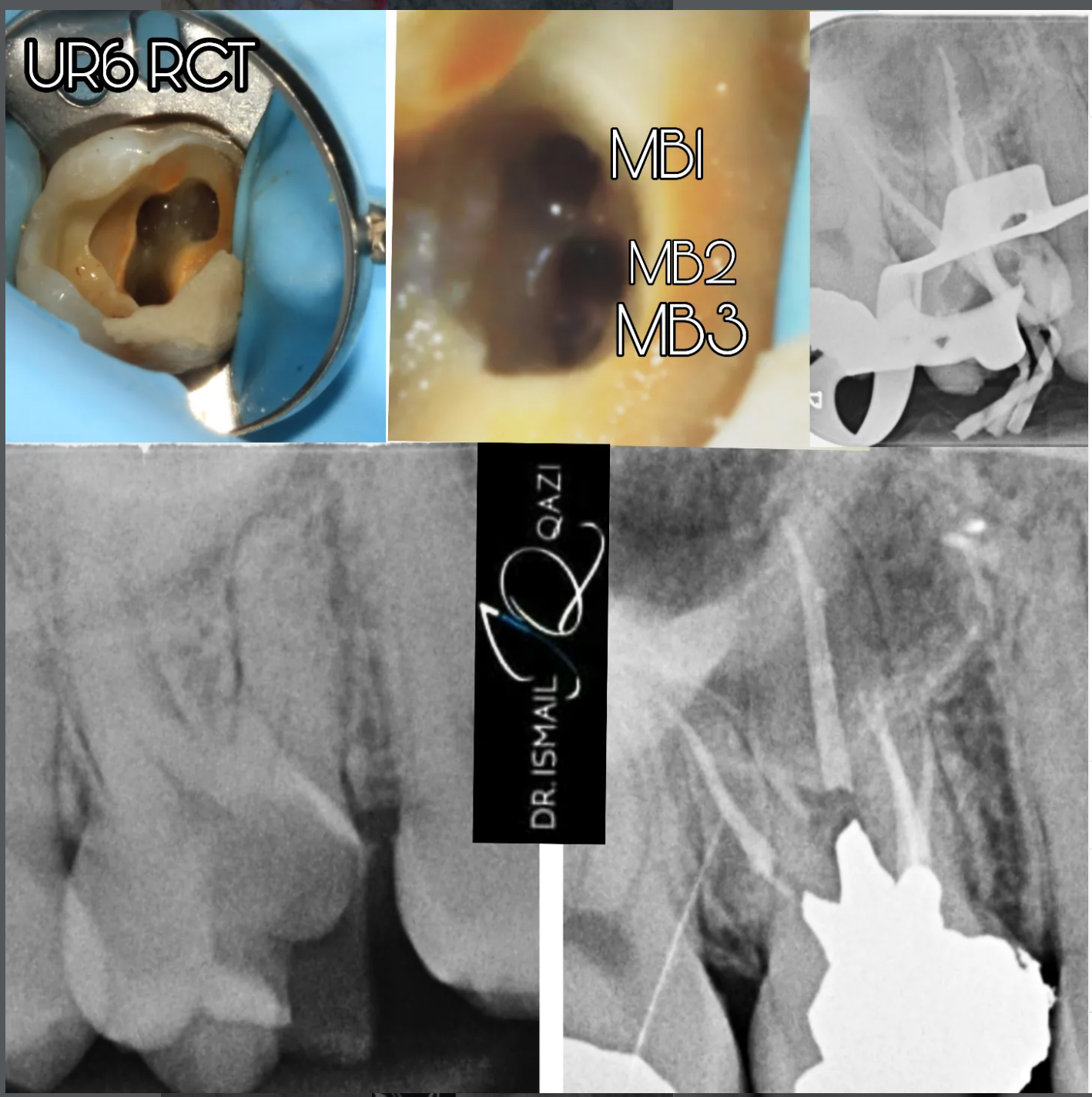 RCT of upper molar with MB2 and MB3