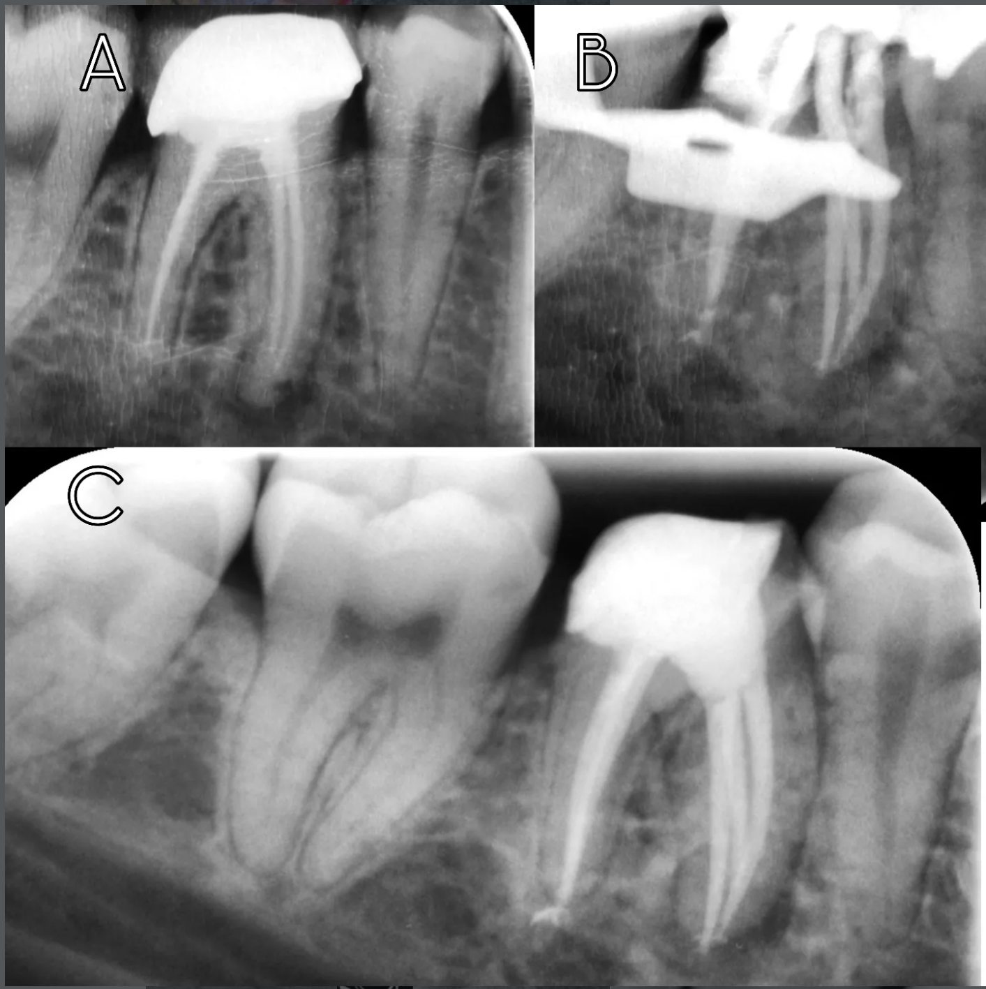 RCT of lower molar with middle mesial canal