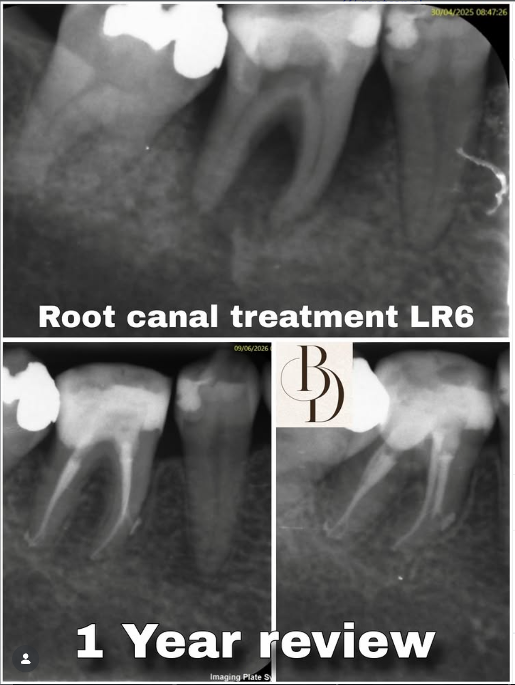 lower molar review of big lesion showing good healing